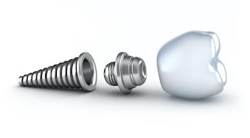 dental implant post greeley co