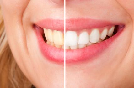 Before and after results from teeth whitening in Greeley CO