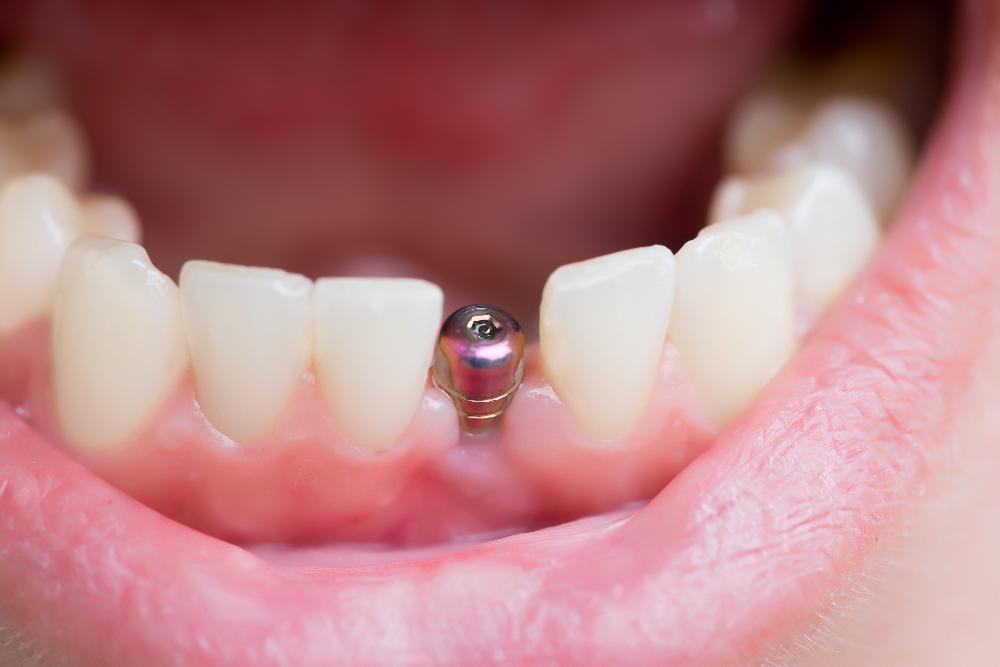 A lower row of teeth with a dental implant screw