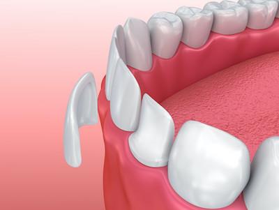 An illustration of a veneer going over a tooth