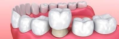 Digital graphic of dental crown covering tooth at Greeley dentist
