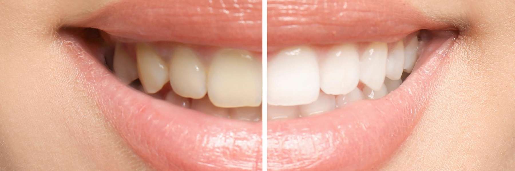 before and after teeth whitening in Greeley, CO
