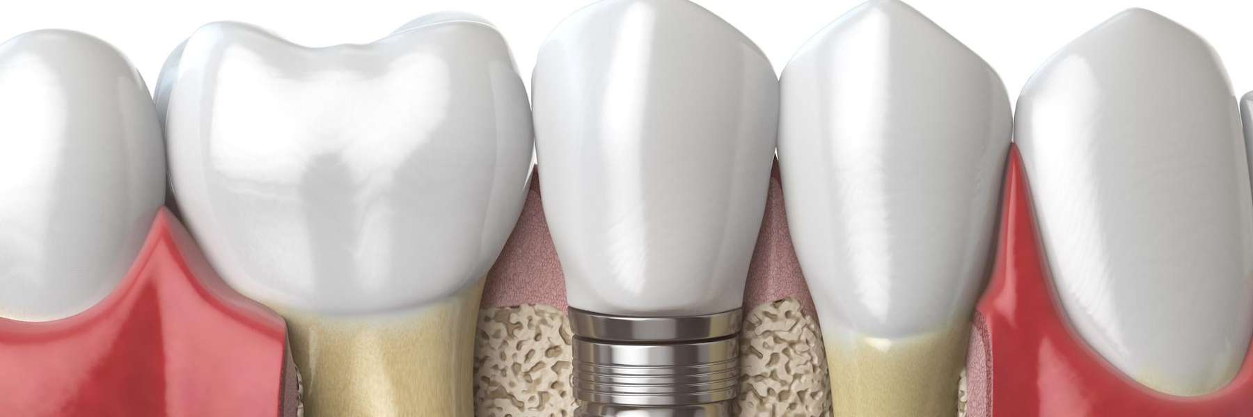 Dental Implants Illustration