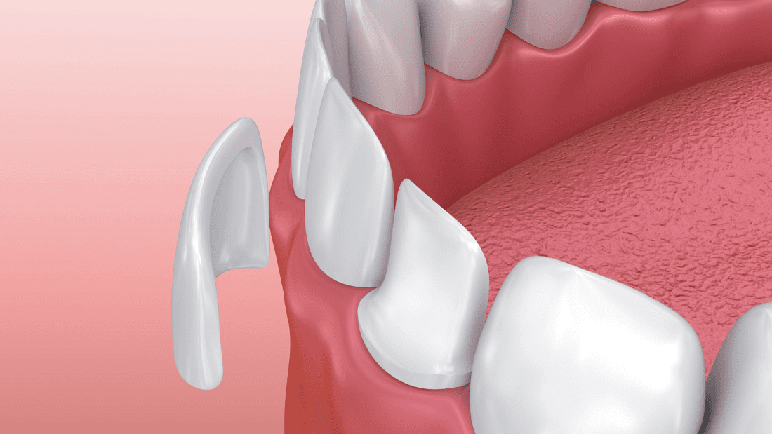 Do Veneers Damage Your Teeth? Blog Dentist in Greeley, CO