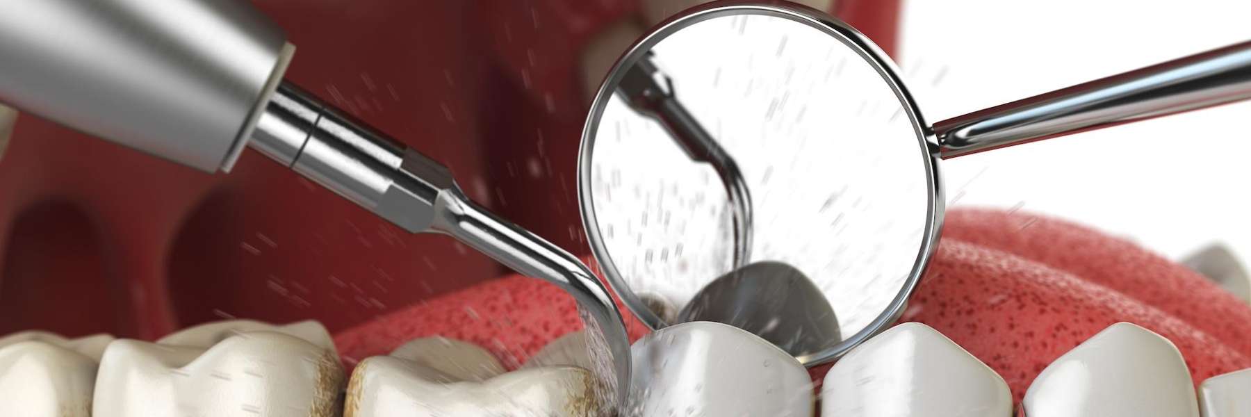 An illustration of a dental cleaning | dentist greeley