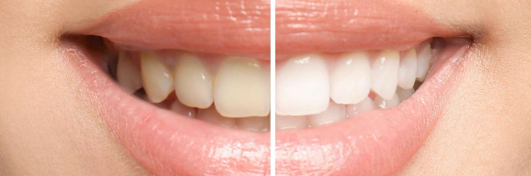 A before and after teeth whitening photo