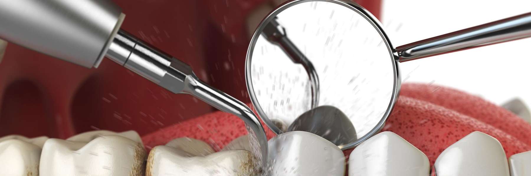 An illustration of a dental cleaning in Greeley