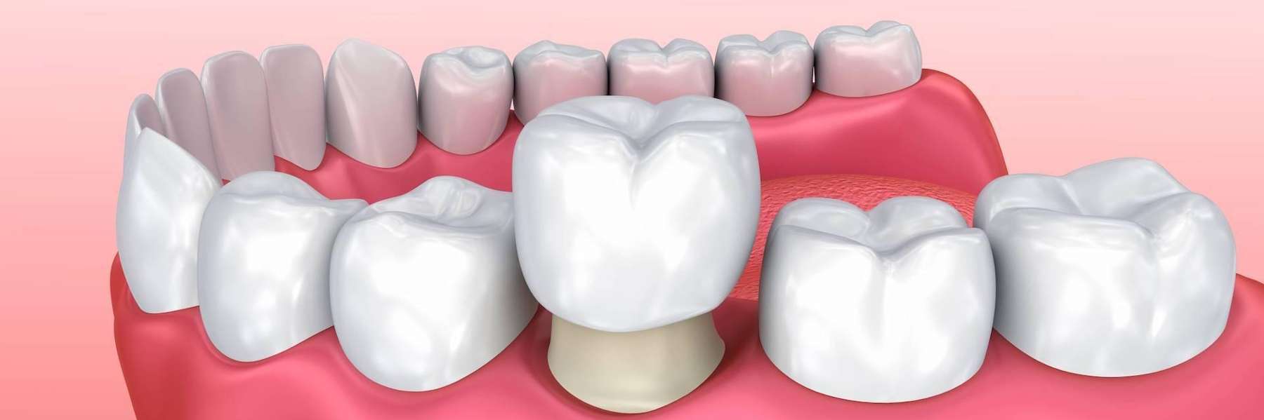 An illustration of a dental crown