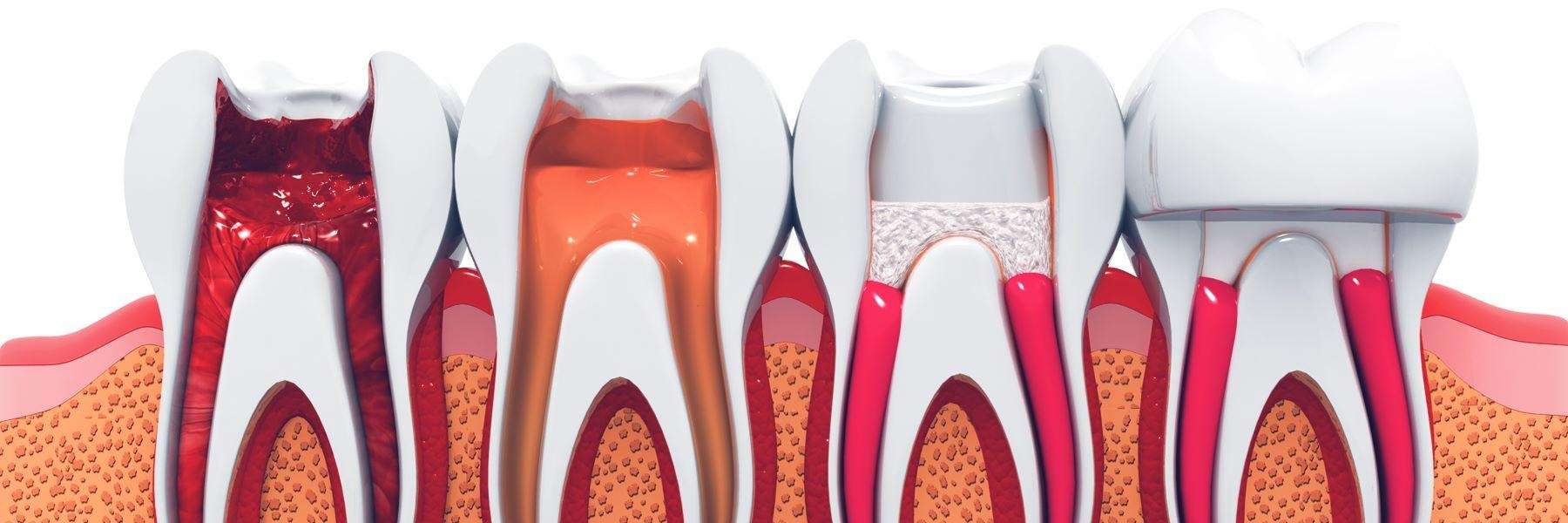 The inside of multiple teeth at varying stages of distress | tooth pain Greeley