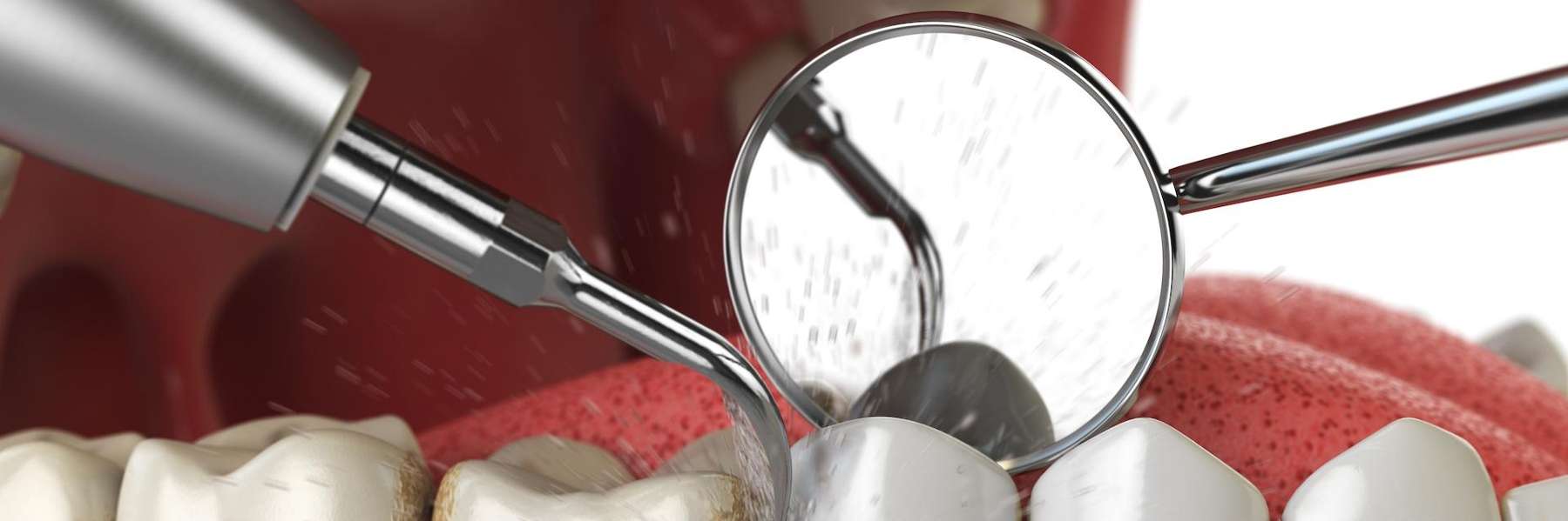 An illustration of a dental cleaning