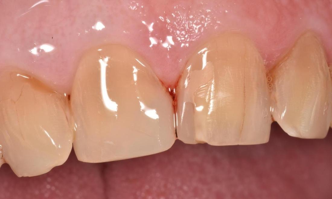 Front teeth after chipped tooth repair in Greeley CO