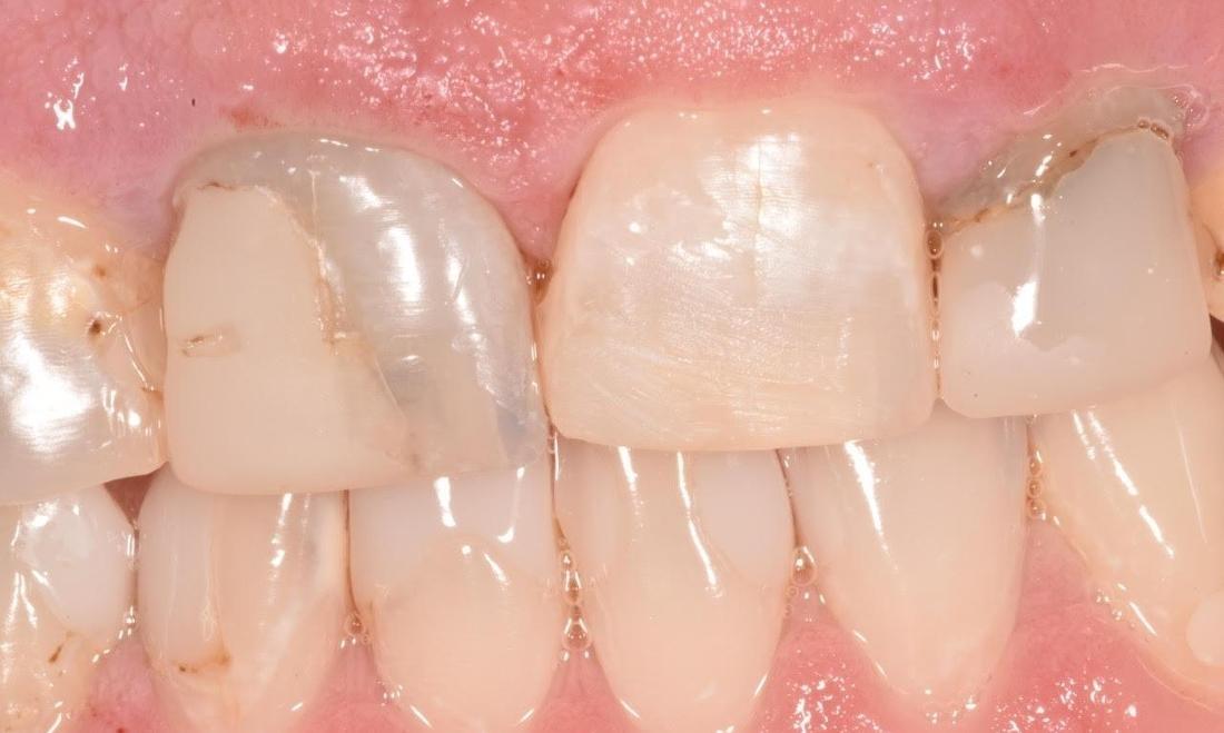 Front teeth after dental bonding in Greeley CO