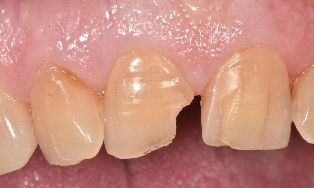Chipped front tooth before cosmetic dentistry in Greeley