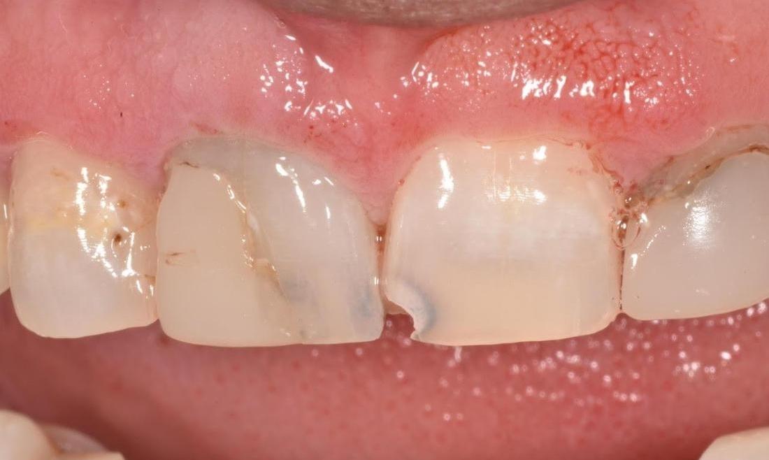 Front teeth before dental bonding in Greeley CO